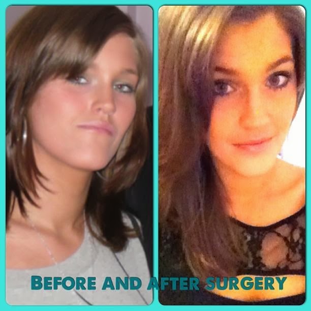 Oral Jaw Surgery 40